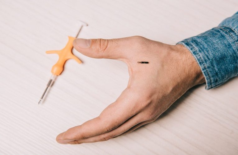 Microchip implantado em mão de mulher viraliza